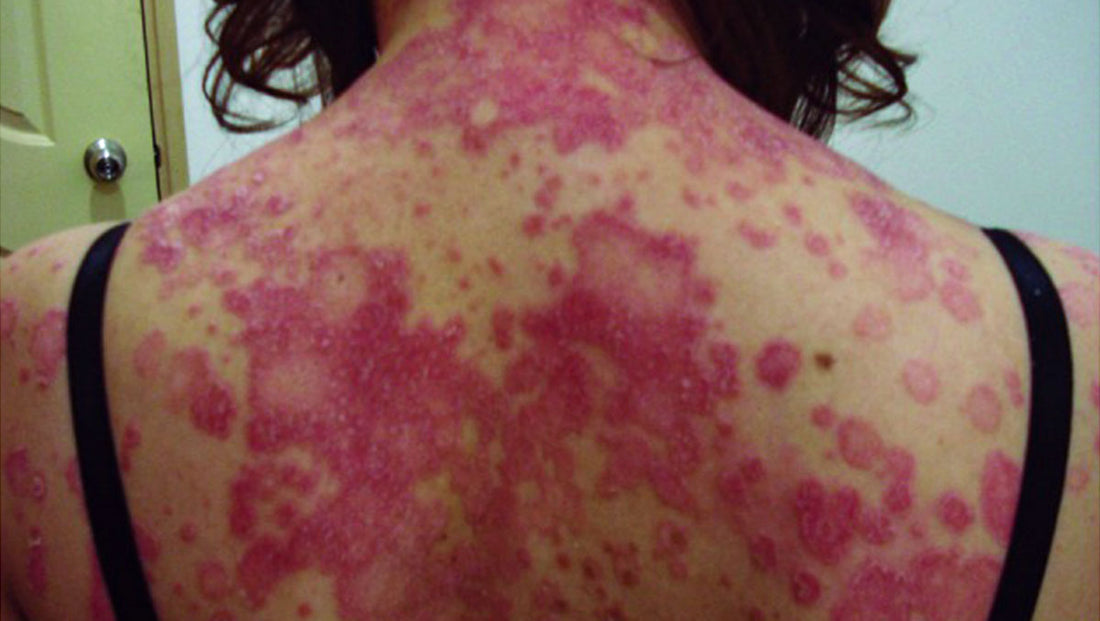 Wirksamkeit der Ernährungstherapie bei Patienten mit Psoriasis: Ein Fallbericht